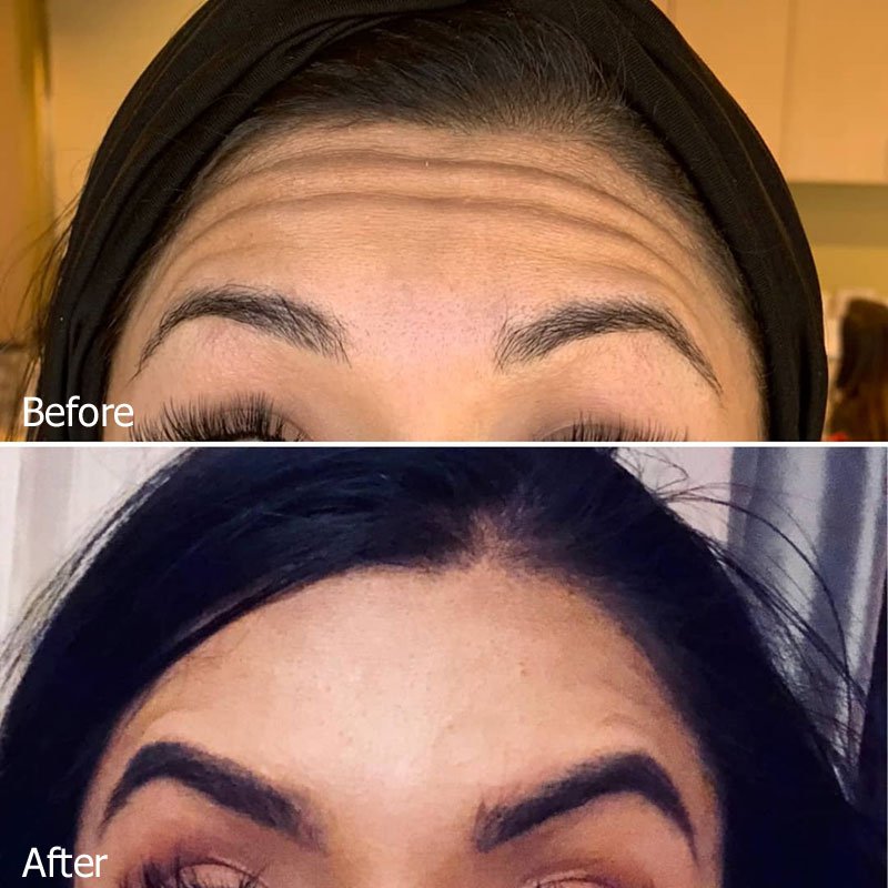 forehead lines before and after treatment