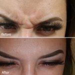 frown lines before and after treatment