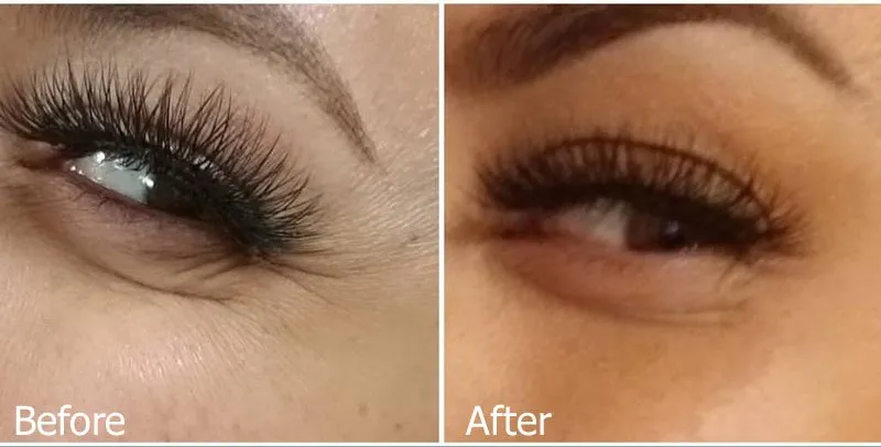 crows feet before and after treatment