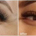 crows feet before and after treatment