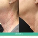Secret RF case 6 before and after pictures