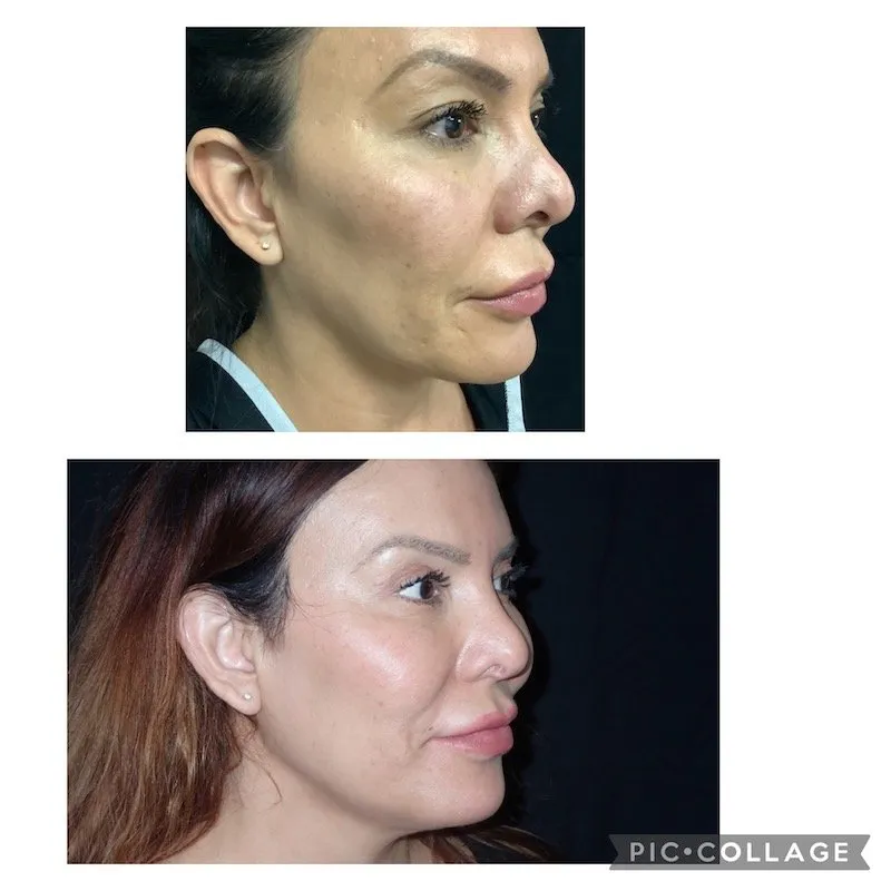 Before & After Image of Jawline Slimming