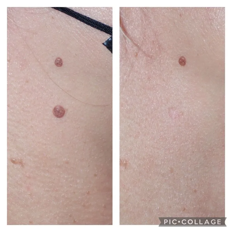 Before & After Image of Mole Removal