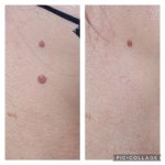 Before & After Image of Mole Removal