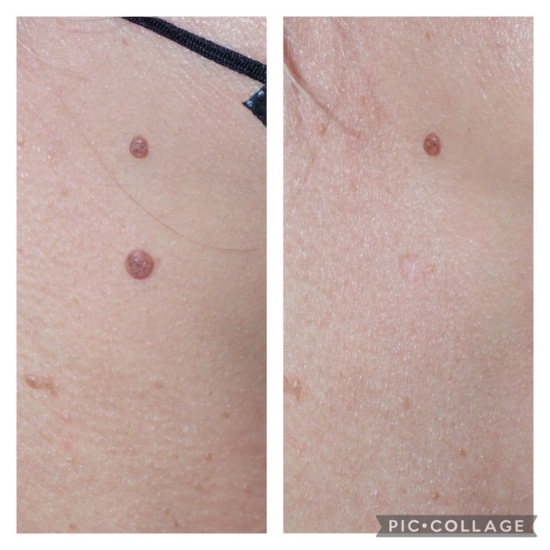 Before & After Image of Mole Removal